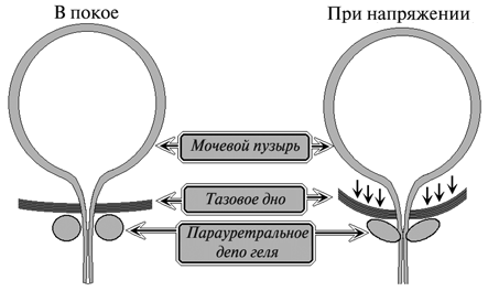 Парауретральная железа у женщин. Генитоуринарный синдром. Генитоуринарный менопаузальный синдром клинические рекомендации. Генитоуринарный синдром в менопаузе. Генитоуринарный синдром клинические рекомендации.