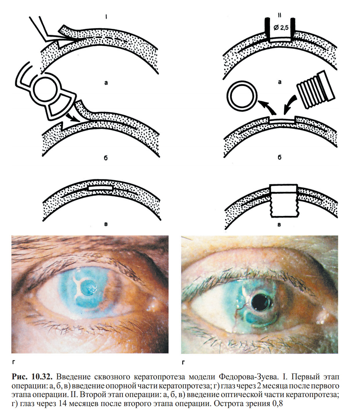 Донор глаза. Сквозная кератопластика этапы операции. Кератоконус роговицы глаз. Перфоративная язва роговицы. Сквозная кератопластика роговицы🙈🙈🙈.