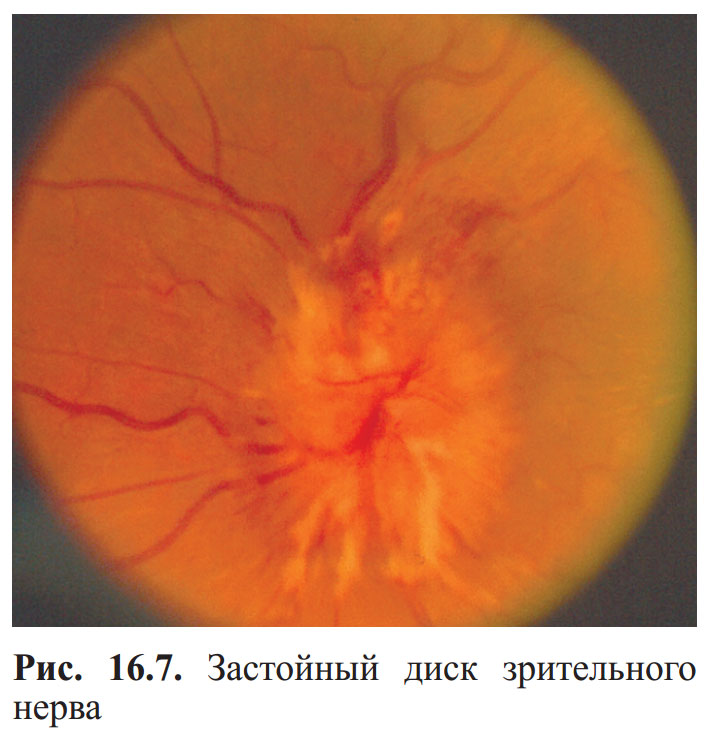Диск глазного нерва. Ретробульбарный неврит зрительного нерва. Диск зрительного нерва проминирует.