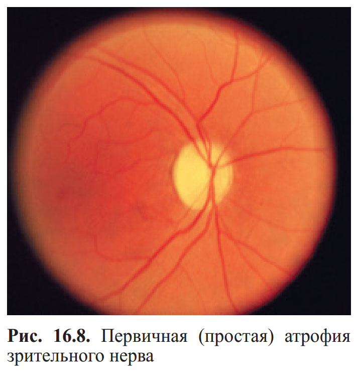 Оптическая нейропатия лебера. Атрофия зрительного нерва Лебера генетика. Офтальмоскопия при атрофии зрительного нерва. Наследственная оптическая нейропатия Лебера. Физиологическая экскавация зрительного нерва.