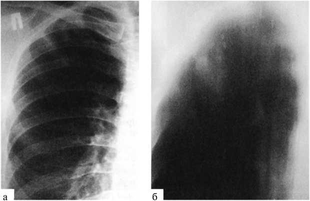 Беспокоит инфильтрат. Инфильтрат брюшной полости кт. Беспокоит инфильтрат. Перивезикальный инфильтрат. Облаковидный инфильтрат рентгенограмма.