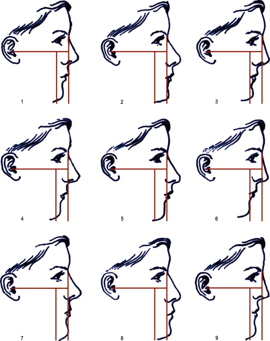 дистальный прикус (птичий профиль). реконструктивная ринопластика. красивый нос. правильный профиль лица. остеотомическая ментопластика.