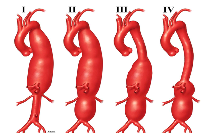 ris1