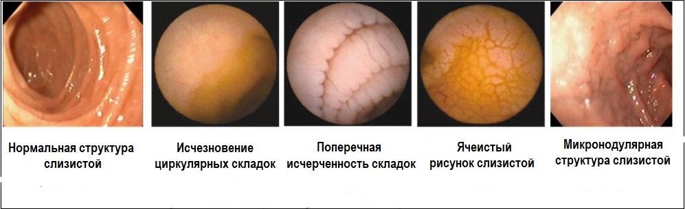 Целиакия