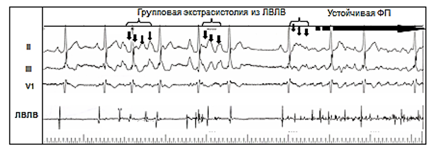 Постоянная форма фибрилляции предсердий карта вызова